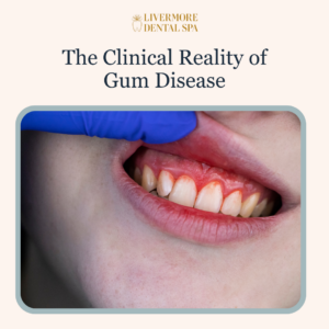 Close-up of red, swollen, and bleeding gum tissue along the tooth baseline, illustrating early signs of gingivitis and periodontal infection.